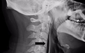 عطسة كسرت رقبة ثلاثيني في بريطانيا